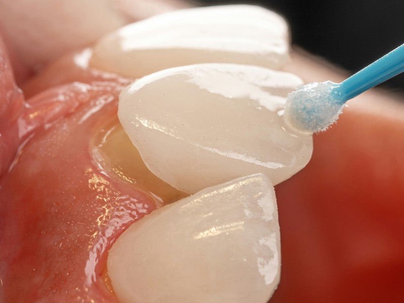 Dental veneer procedure for improving smile appearance and tooth shape