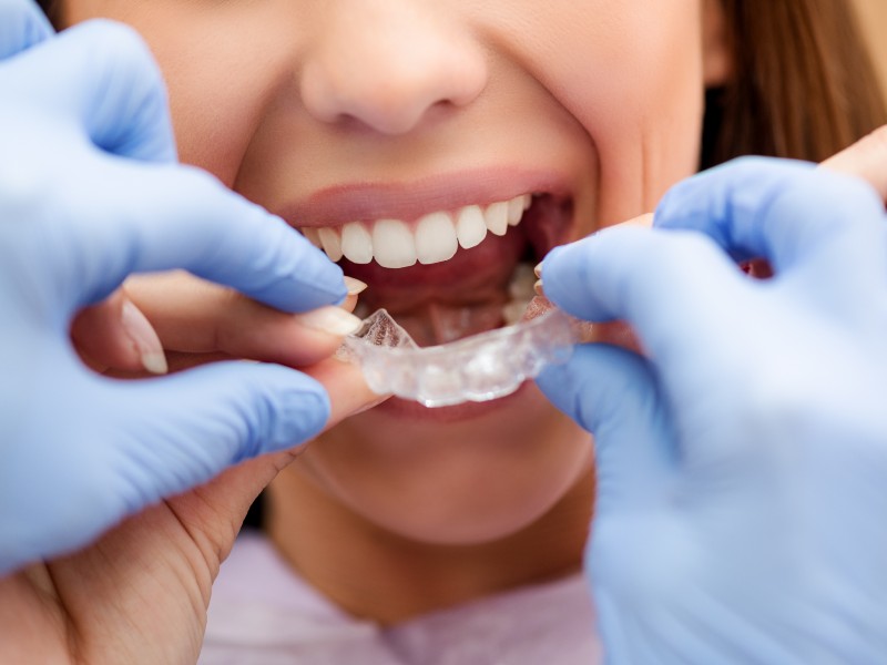 Patient wearing clear aligners during Invisalign treatment consultation